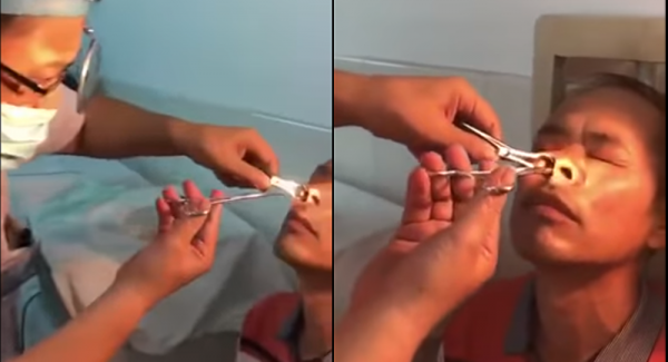 شاهد ماذا أخرج طبيب من أنف مريضه (فيديو)