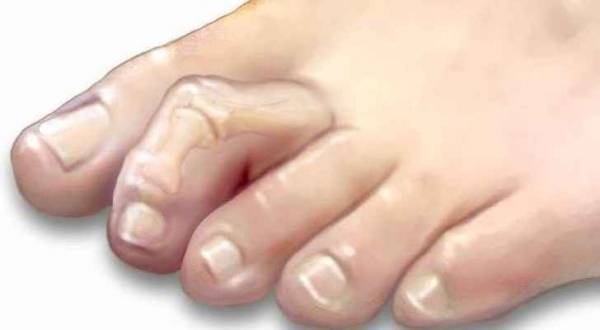 أسباب الإصابة بإصبع القدم المطرقية وطرق الوقاية منه!