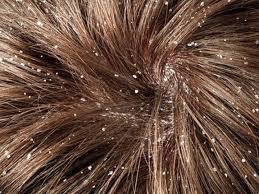 10 أسباب لظهور قشرة الرأس